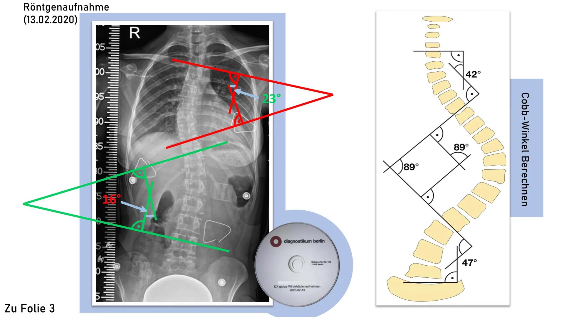 Skoliose -Korsettbehandlung
eine Erfolgsgeschichte? R
BS
1 Begriffsbestimmung
1.1
Definition
1.2 Beschreibung
2 Krankheitsbild
2.1 Ursachen
