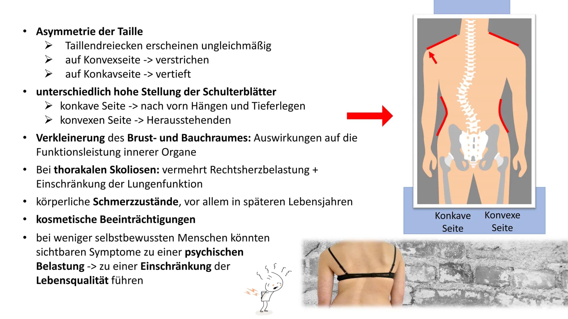 Skoliose -Korsettbehandlung
eine Erfolgsgeschichte? R
BS
1 Begriffsbestimmung
1.1
Definition
1.2 Beschreibung
2 Krankheitsbild
2.1 Ursachen
