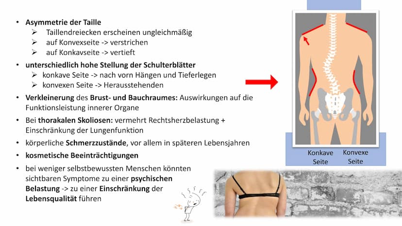 Skoliose -Korsettbehandlung
eine Erfolgsgeschichte? R
BS
1 Begriffsbestimmung
1.1
Definition
1.2 Beschreibung
2 Krankheitsbild
2.1 Ursachen
