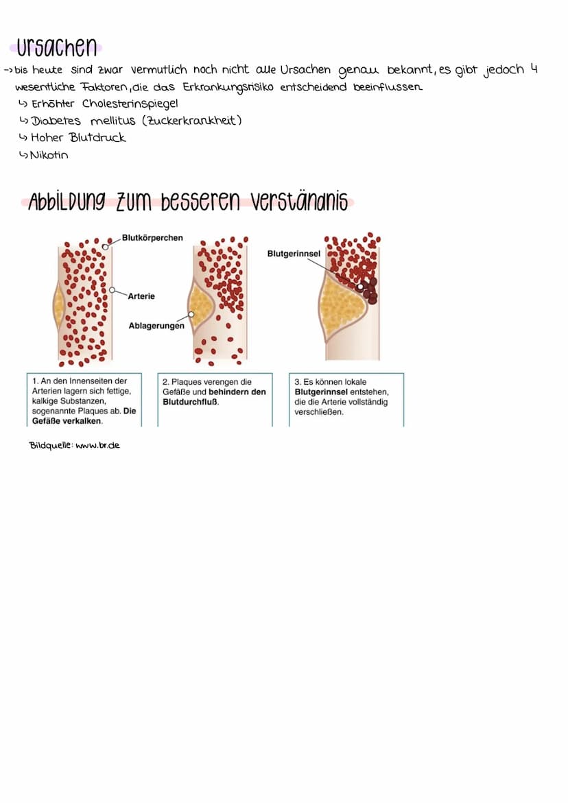 Arteriosklerose
Definition
- Arteriosklerose -> umgangssprachlich: Arterienverkalkung
- Erklärung der Schlagadern im Körper (Arterien)
- Blu