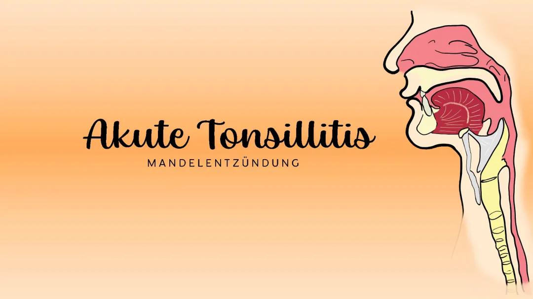 Akute Tonsillitis