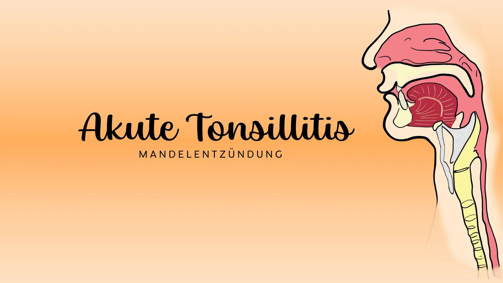 Akute Tonsillitis
MANDELENTZÜNDUNG
010020 Was versteht man unter einer akuten Tonsillitis?
Unter der akuten Tonsillitis versteht man eine ak
