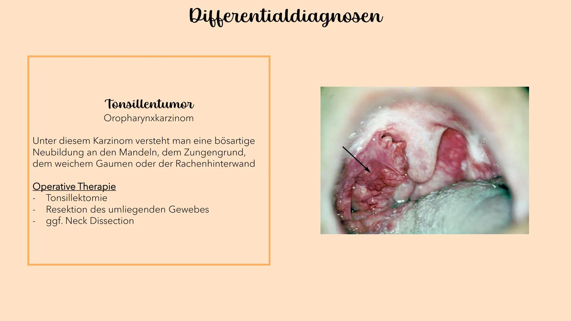 Akute Tonsillitis
MANDELENTZÜNDUNG
010020 Was versteht man unter einer akuten Tonsillitis?
Unter der akuten Tonsillitis versteht man eine ak