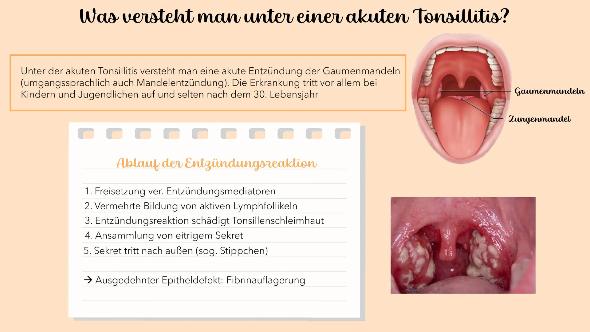 Akute Tonsillitis
MANDELENTZÜNDUNG
010020 Was versteht man unter einer akuten Tonsillitis?
Unter der akuten Tonsillitis versteht man eine ak