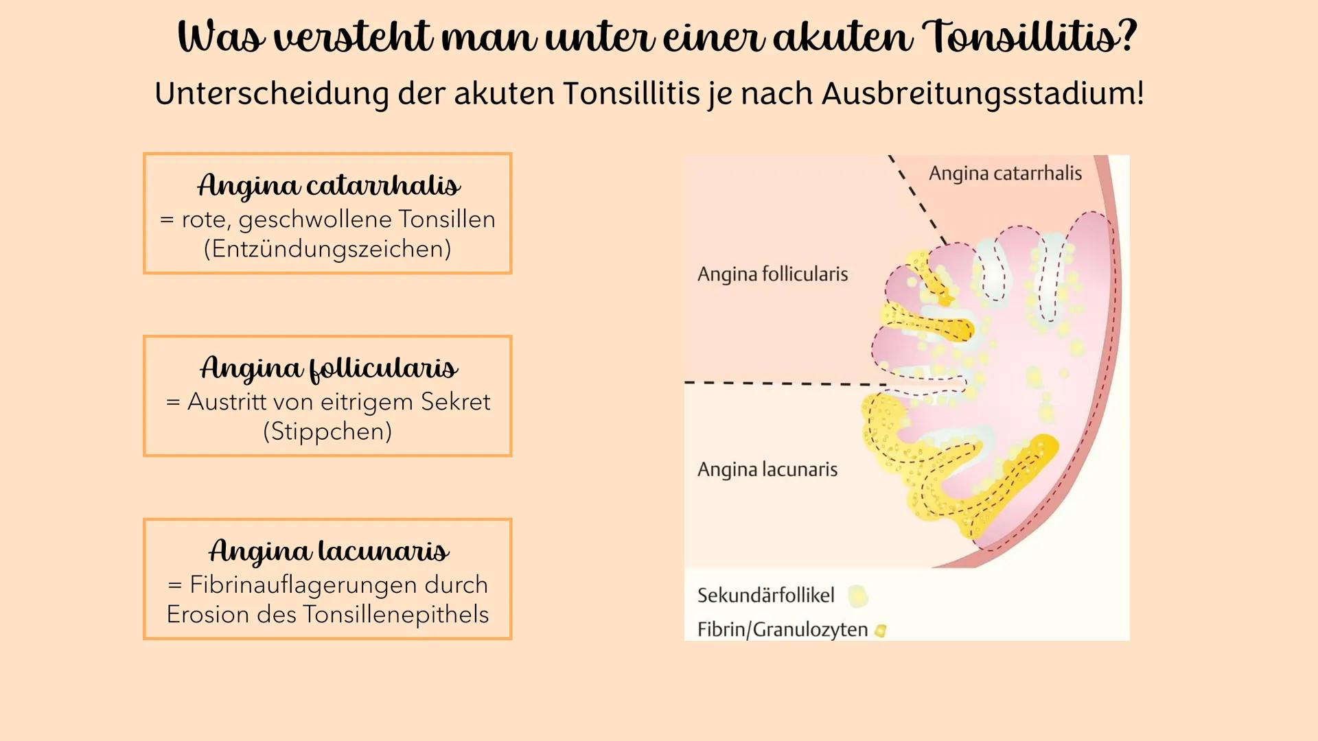 Akute Tonsillitis
MANDELENTZÜNDUNG
010020 Was versteht man unter einer akuten Tonsillitis?
Unter der akuten Tonsillitis versteht man eine ak