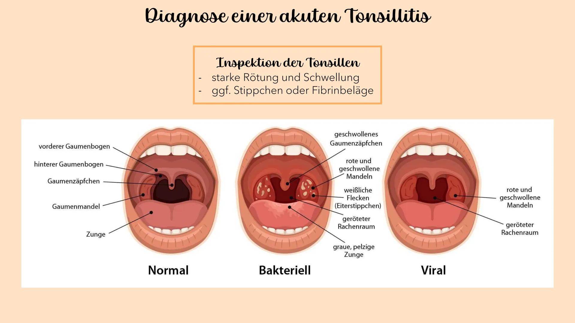 Akute Tonsillitis
MANDELENTZÜNDUNG
010020 Was versteht man unter einer akuten Tonsillitis?
Unter der akuten Tonsillitis versteht man eine ak