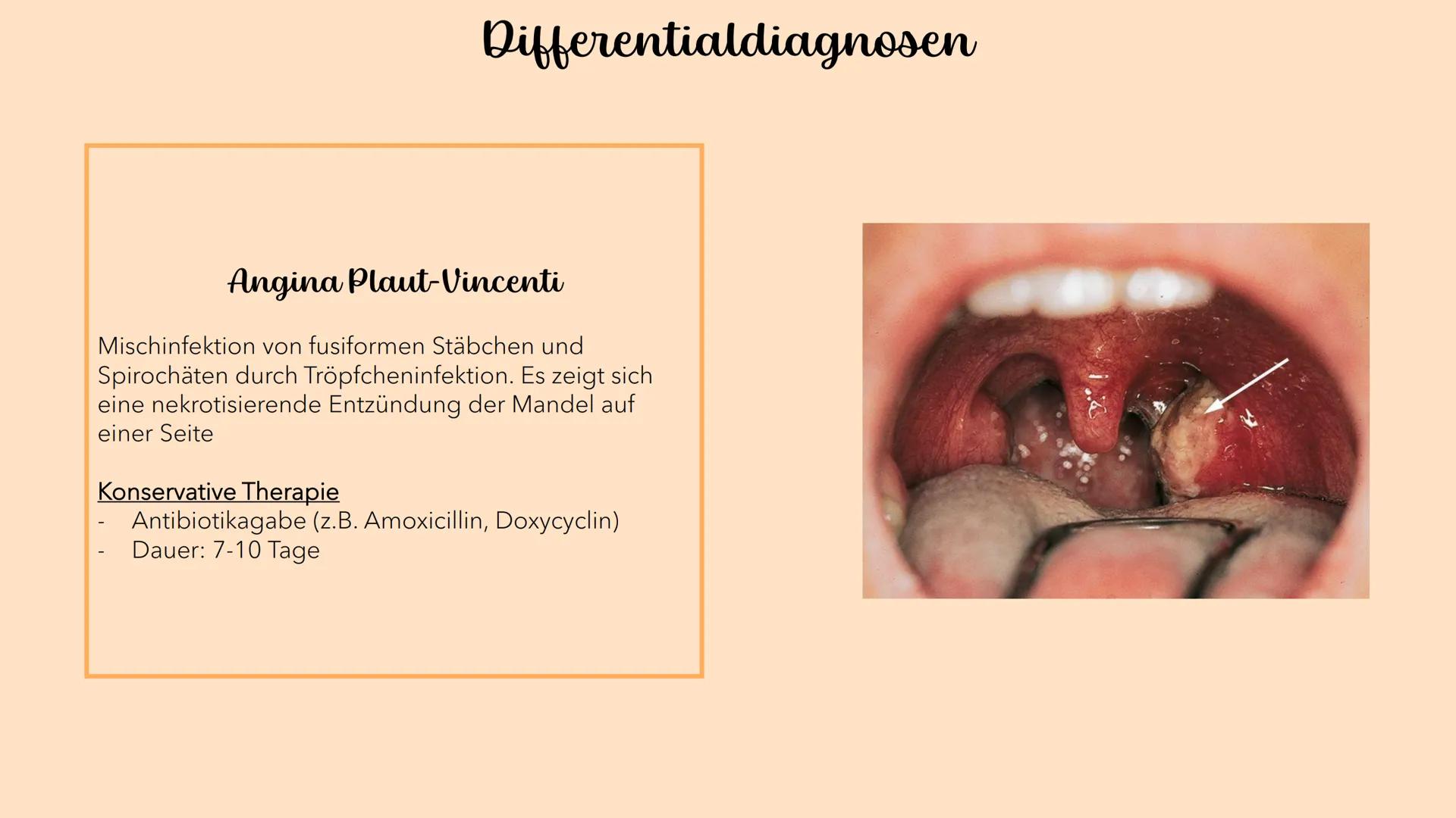 Akute Tonsillitis
MANDELENTZÜNDUNG
010020 Was versteht man unter einer akuten Tonsillitis?
Unter der akuten Tonsillitis versteht man eine ak