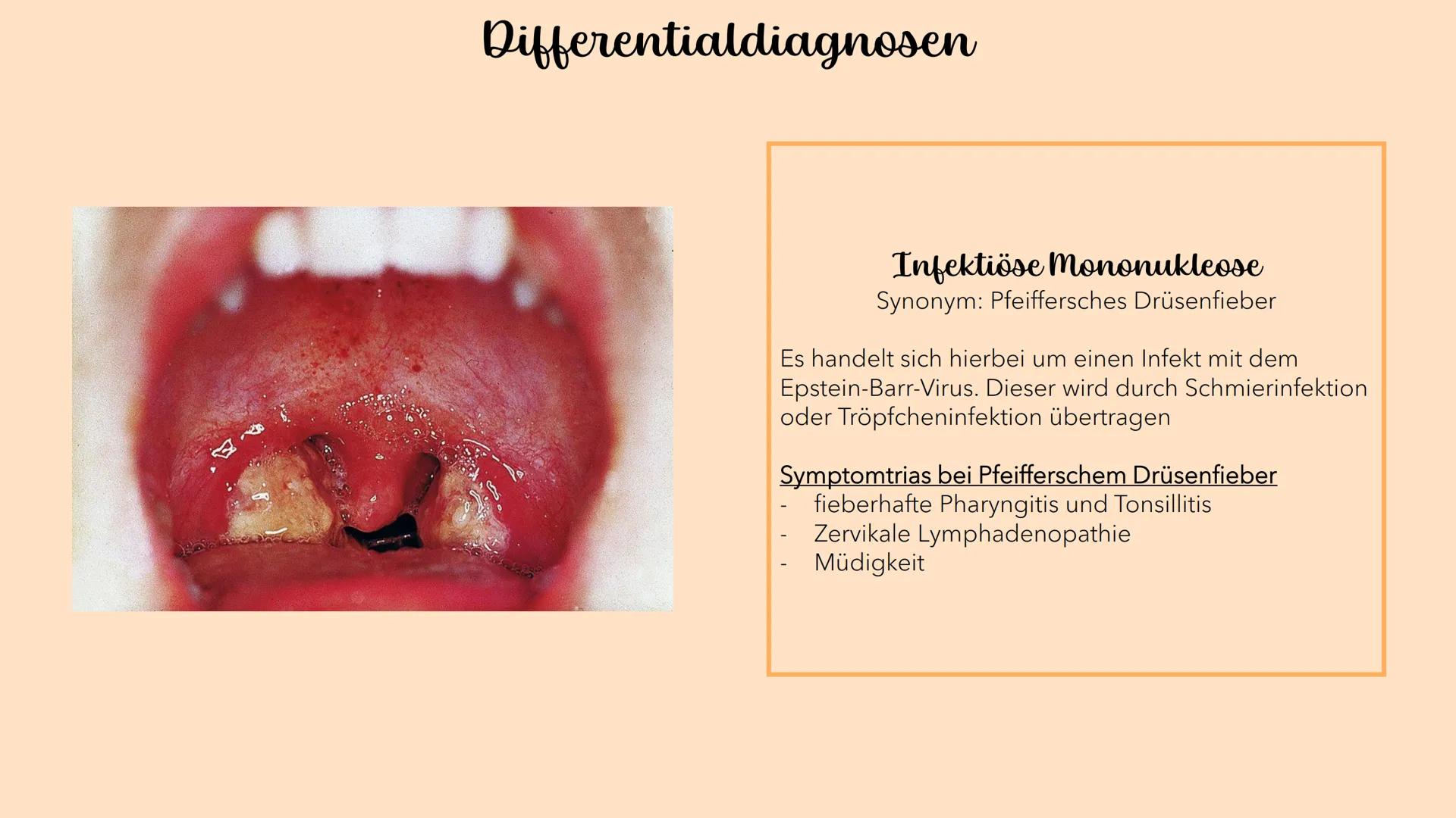Akute Tonsillitis
MANDELENTZÜNDUNG
010020 Was versteht man unter einer akuten Tonsillitis?
Unter der akuten Tonsillitis versteht man eine ak