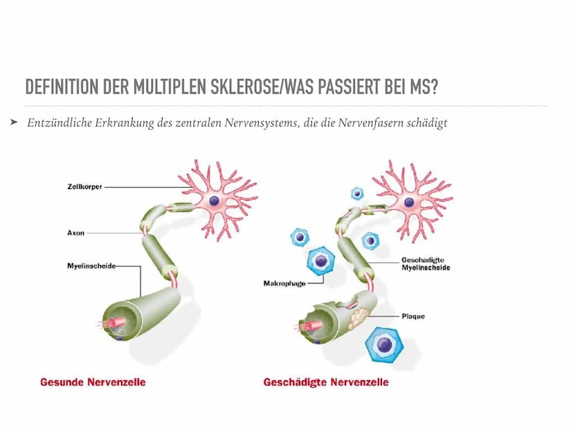 Multiple Sklerose
Definition
Multiple Sklerose = Enzephalitis disseminata
Eine entzündliche Erkrankung des zentralen Nervensystems, die die 