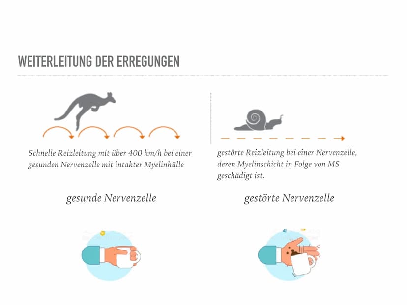Multiple Sklerose
Definition
Multiple Sklerose = Enzephalitis disseminata
Eine entzündliche Erkrankung des zentralen Nervensystems, die die 