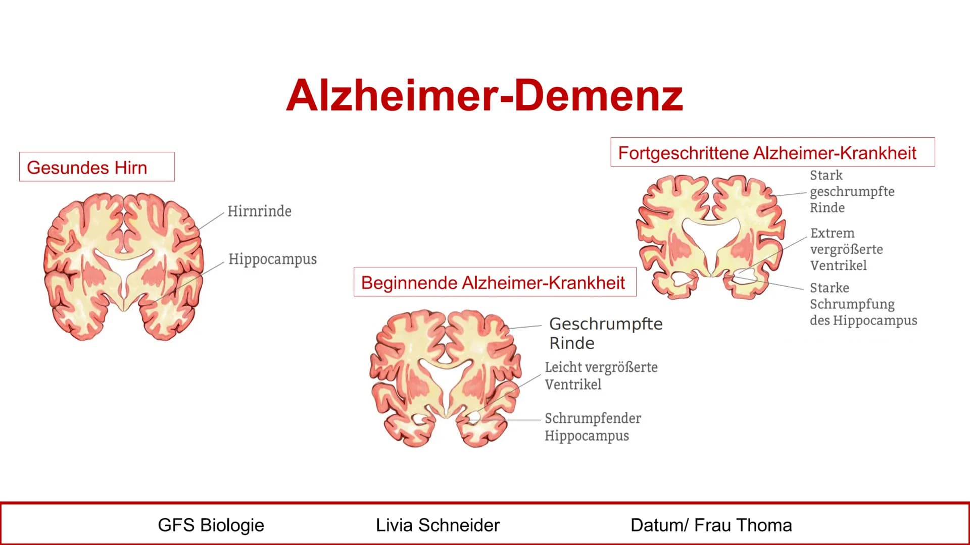 Gesundes Hirn
38
Alzheimer-Demenz
Hirnrinde
Hippocampus
GFS Biologie
Fortgeschrittene Alzheimer-Krankheit
Stark
- geschrumpfte
Rinde
Extrem
