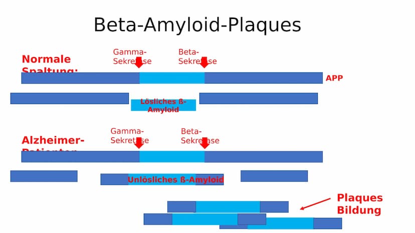 Gesundes Hirn
38
Alzheimer-Demenz
Hirnrinde
Hippocampus
GFS Biologie
Fortgeschrittene Alzheimer-Krankheit
Stark
- geschrumpfte
Rinde
Extrem

