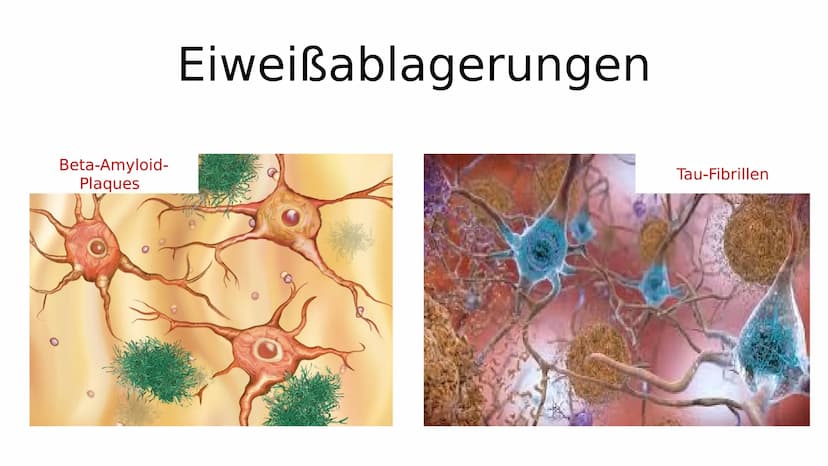 Gesundes Hirn
38
Alzheimer-Demenz
Hirnrinde
Hippocampus
GFS Biologie
Fortgeschrittene Alzheimer-Krankheit
Stark
- geschrumpfte
Rinde
Extrem
