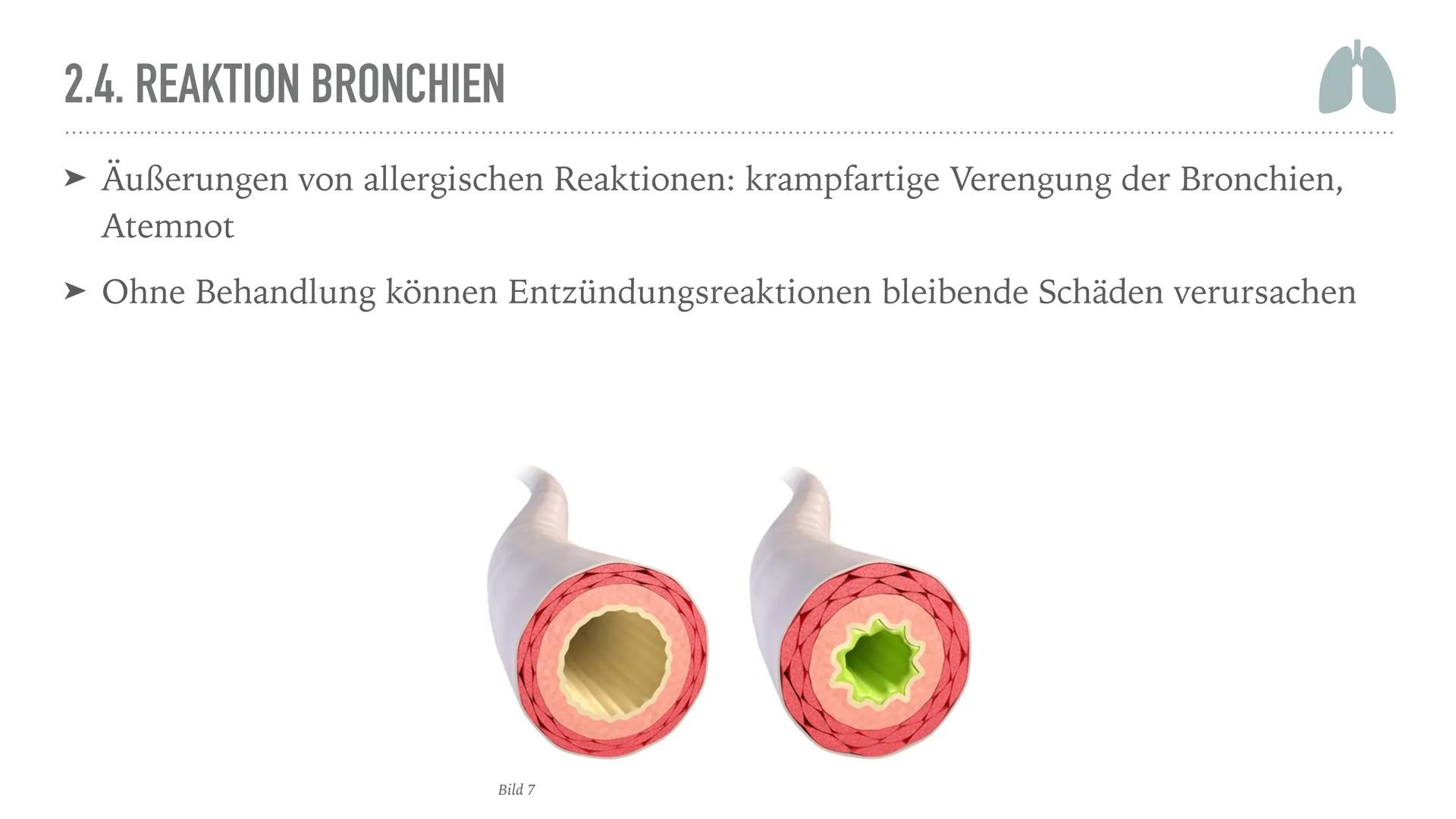 ALLERGIEN
Alicia Saalmann, Timo Streek und Helena Schulze INHALT
1. Wie entsteht eine Allergie?
2. Definition und Krankheitsbild
2.1. Reakti