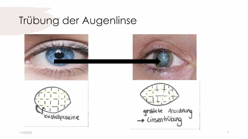 
<h2 id="ursachen">Ursachen</h2>
<p>Der Graue Star, auch bekannt als Katarakt, tritt in der Regel im Alter auf und resultiert in der Eintrüb