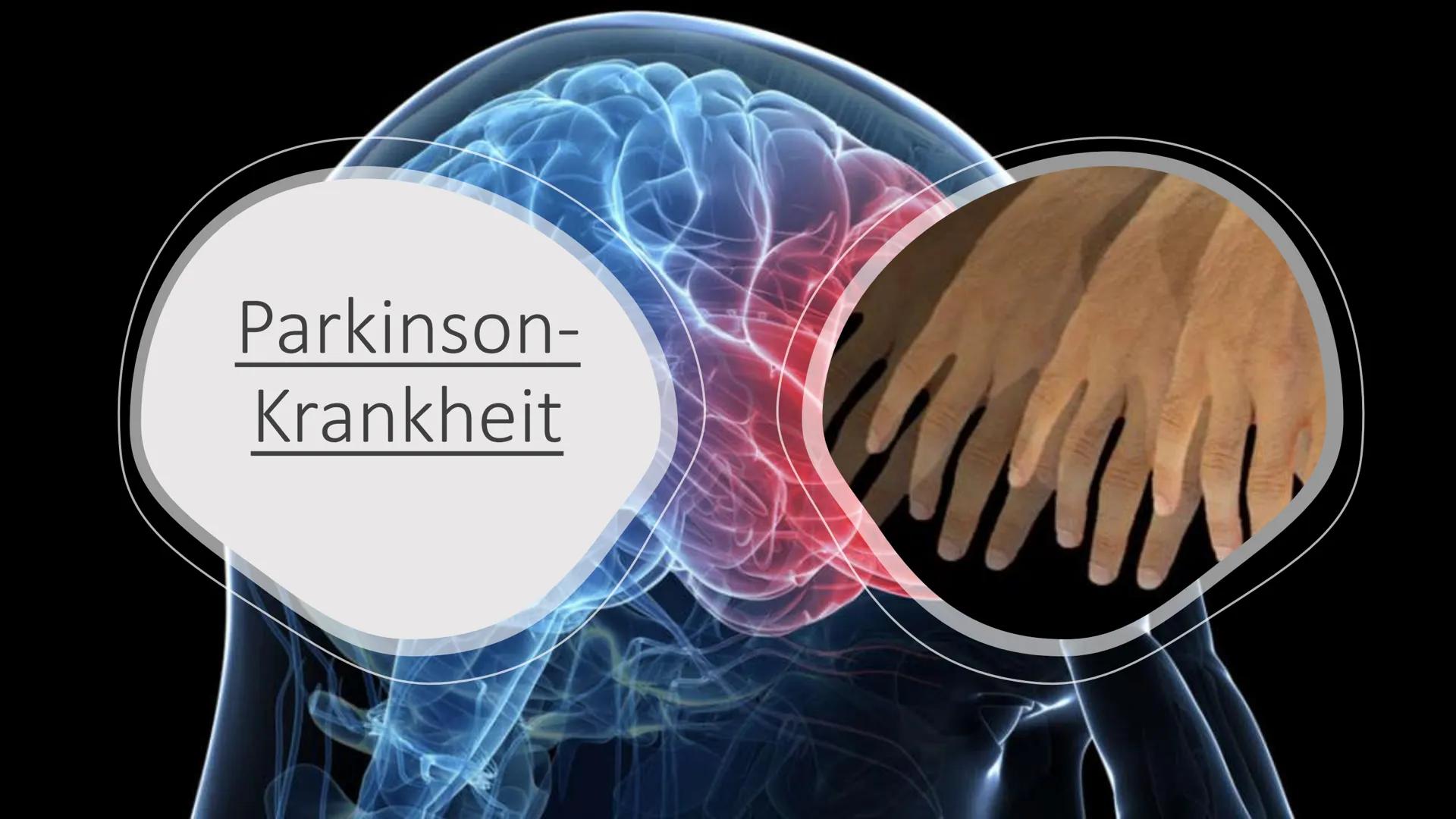 Parkinson-
Krankheit Inhaltsverzeichnis
●
●
●
●
●
Begriffserklärung
Allgemeines
Typische Symptome
Frühsymptome
Begleitsymptome
Ursachen
Ther