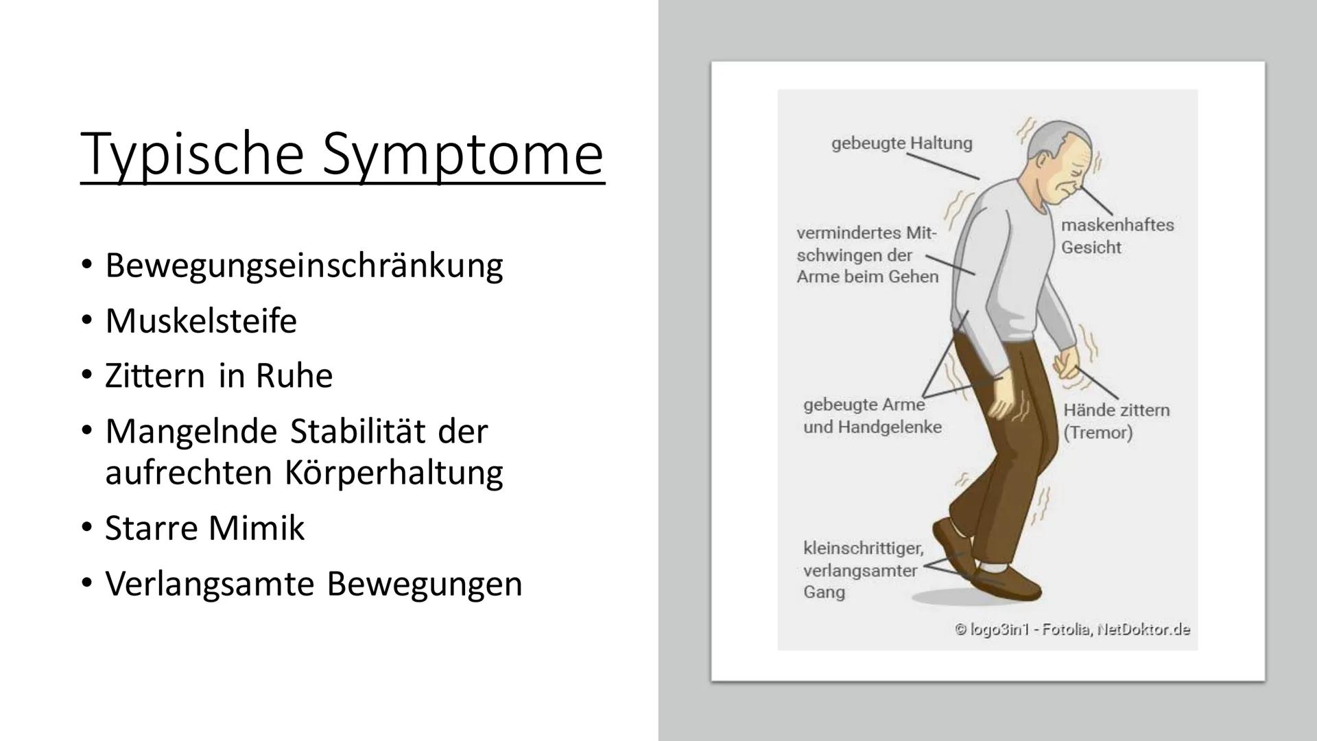 Parkinson-
Krankheit Inhaltsverzeichnis
●
●
●
●
●
Begriffserklärung
Allgemeines
Typische Symptome
Frühsymptome
Begleitsymptome
Ursachen
Ther