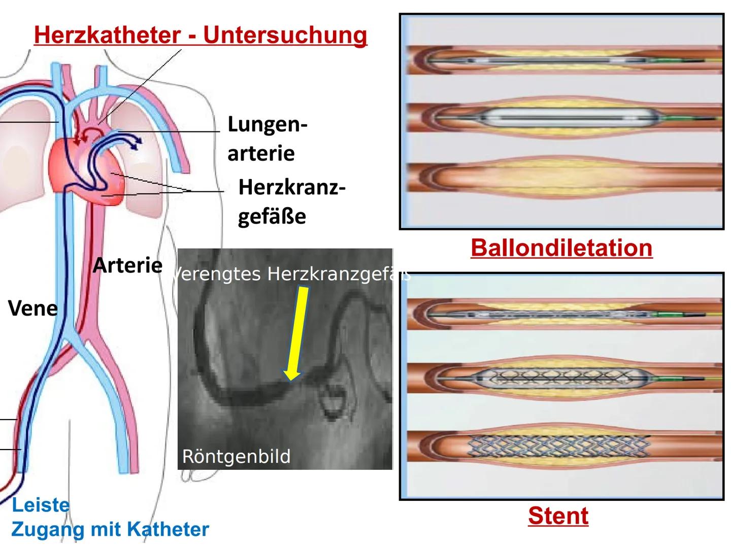 Der Herzkreislauf
und
Herz-Kreislauferkrankungen
Leitfrage:
Jährlich sterben Millionen von Menschen allein in Deutschland an
Herzkreislaufer