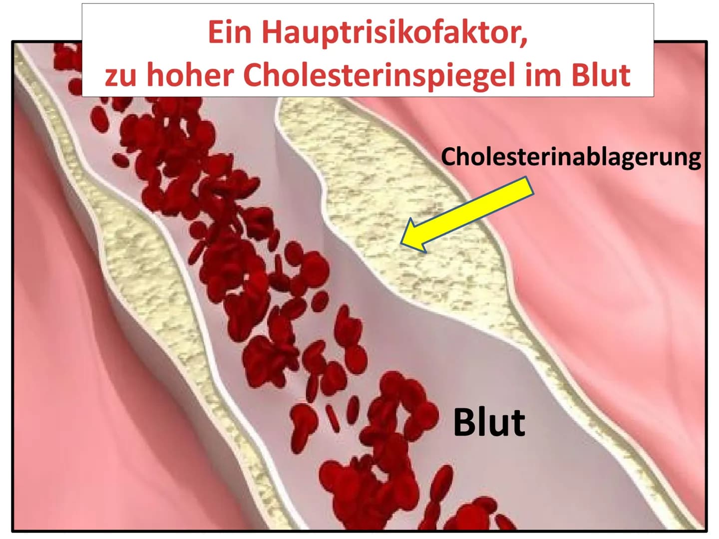 Der Herzkreislauf
und
Herz-Kreislauferkrankungen
Leitfrage:
Jährlich sterben Millionen von Menschen allein in Deutschland an
Herzkreislaufer