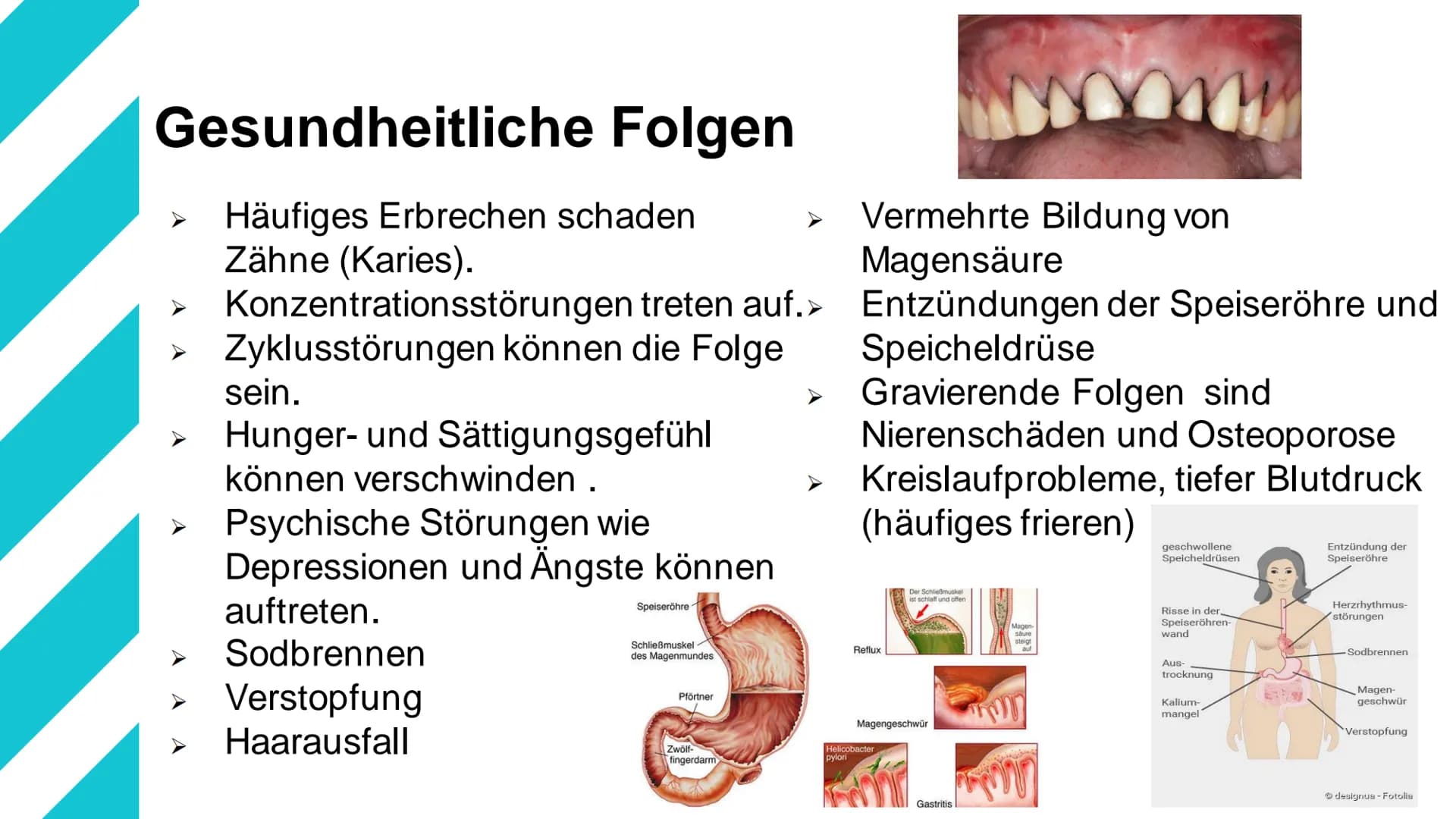Bulimie Gliederung
1. Definition
2. Ursachen/Entstehung
3. Betroffene Personen
4. Verlauf der Krankheit
5. Symptome
6. Gesundheitliche Folge