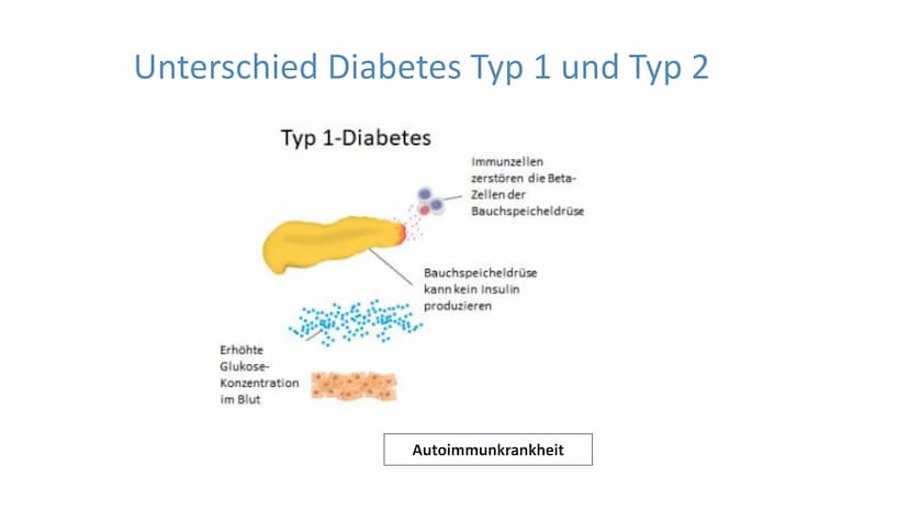 "Altersdiabetes"
im Jugendalter
Inwiefern ist die
Erkrankung heilbar?
lai Was ist Diabetes Typ 2?
Unterscheidung Diabetes Typ 1 und Typ 2
De
