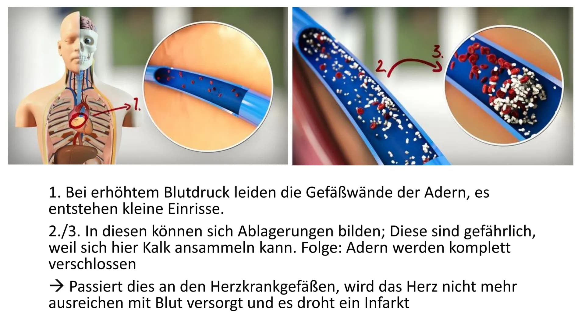 Bluthochdruck
Biologie / Klasse / Name / Datum Allgemein
• ,,arterille Hypertonie"
Der Blutdruck des arteriellen Gefäßsystems ist chronisch 