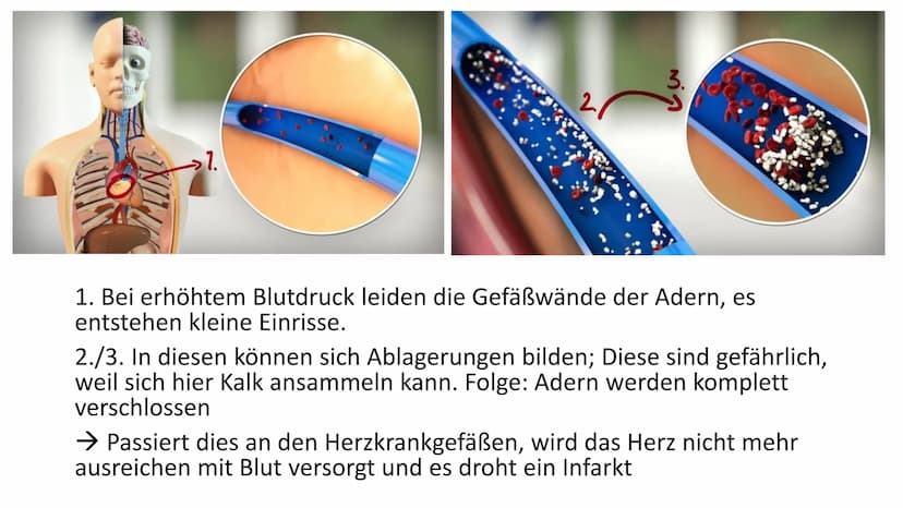 Bluthochdruck
Biologie / Klasse / Name / Datum Allgemein
• ,,arterille Hypertonie"
Der Blutdruck des arteriellen Gefäßsystems ist chronisch 