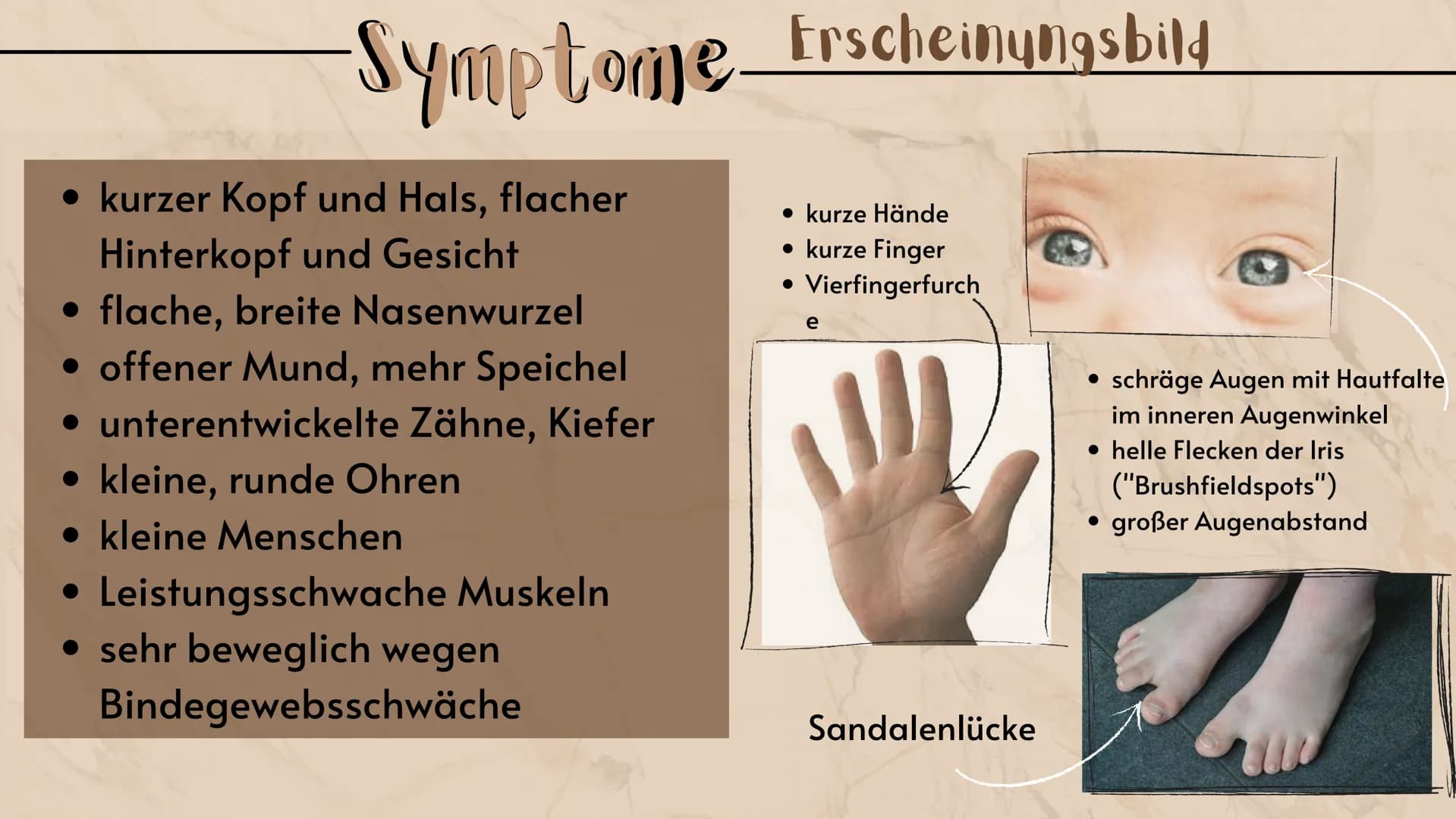 O
Down-Syndrom
eine Erbkrankheit?
Präsentation
Sarah Keller
13.01.2021
BIO LK
HB Gliederung E
Was ist ein Syndrom?
Down-Syndrom-Ein Syndrom?