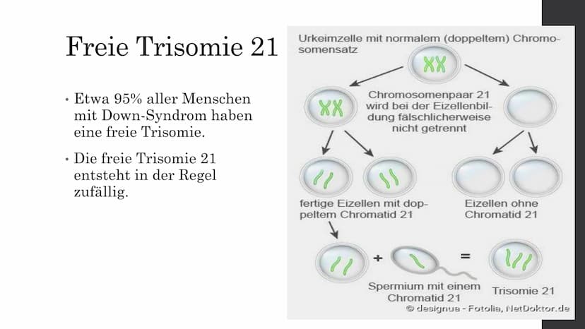 Trisomie 21
Von Elisabeth A. Inhaltsverzeichnis
Was ist Trisomie 21?
Die Formen der Trisomie 21
. Die Geschichte des Down-Syndroms
●
●
Die v
