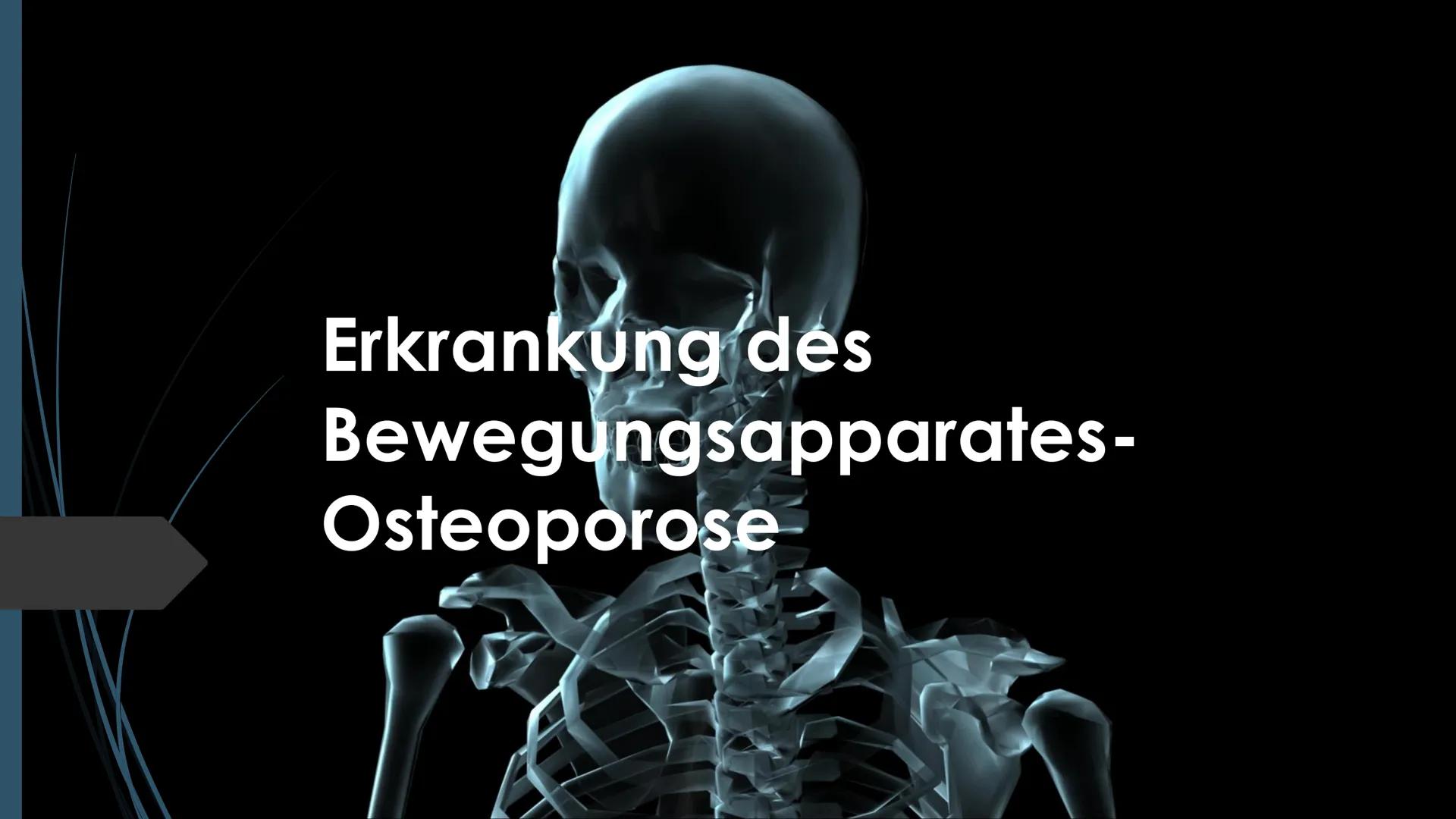 Erkrankung des
Bewegungsapparates-
Osteoporose Inhalt
●
●
●
●
●
●
●
Definition
Ursache
Symptome
Risikofaktoren
Diagnose
Therapie
Anwendungsb