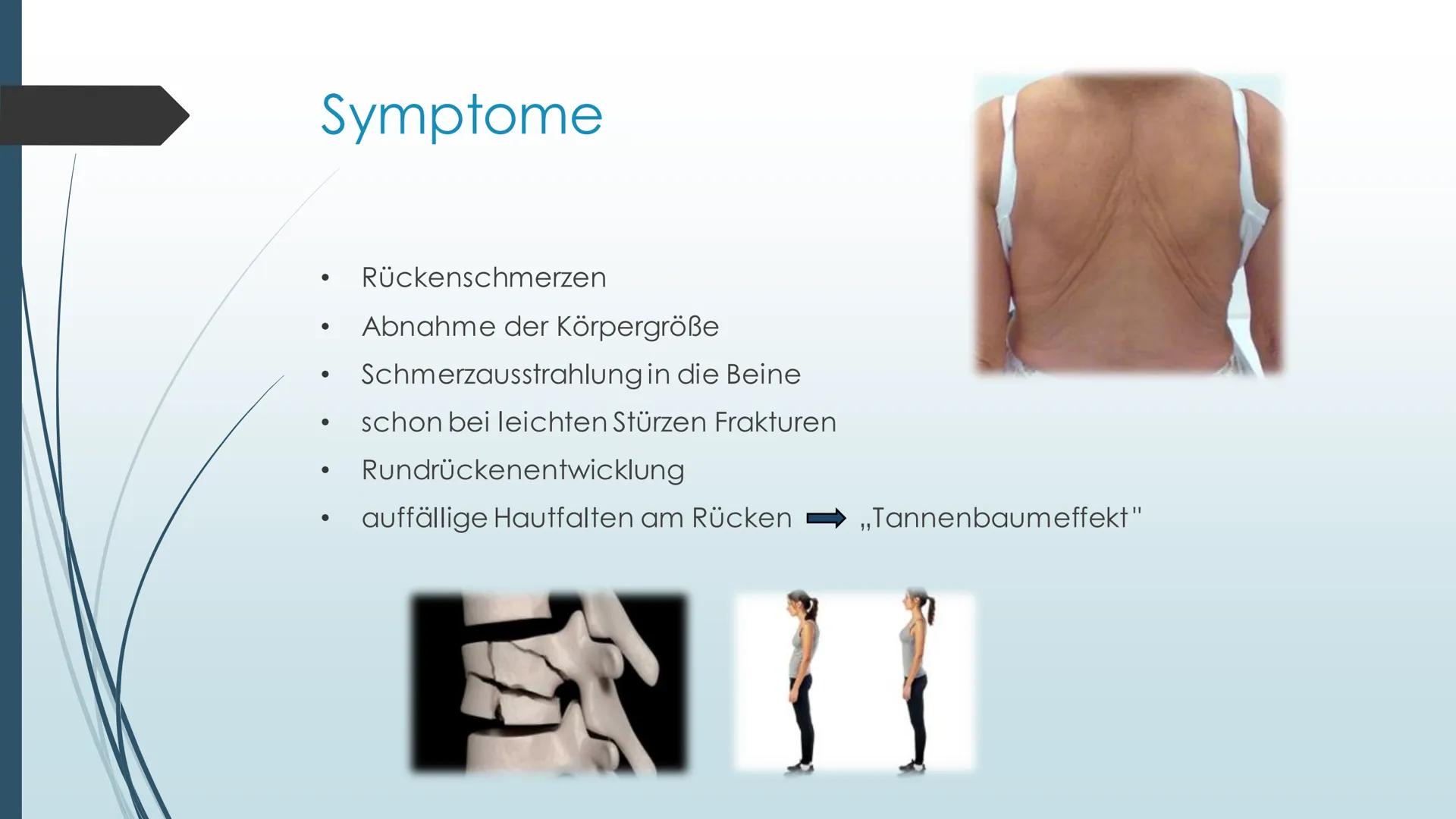 Erkrankung des
Bewegungsapparates-
Osteoporose Inhalt
●
●
●
●
●
●
●
Definition
Ursache
Symptome
Risikofaktoren
Diagnose
Therapie
Anwendungsb