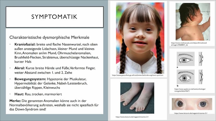 TRISOMIE 21
Victoria Römisch-27.04.21
QII-Bio-Sandt I. Grundlegendes
o Downsyndrom
o Symptomatik
o Auswirkungen
2. Genetik
o Das dritte Chro