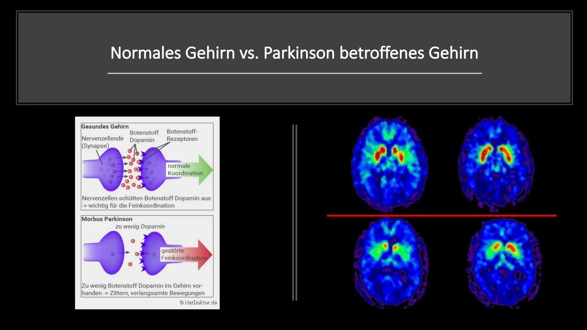 Morbus Parkinson
(Schüttellähmung) Themen
• Was ist Parkinson?
Wissenswertes
●
Normales Gehin vs. Parkinson betroffenes Gehirn
Ursachen
• Sy