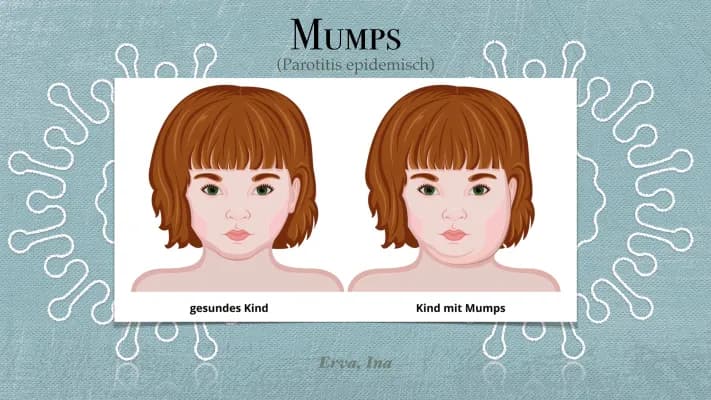 Know Mumps (Krankheit: Mumps)  thumbnail