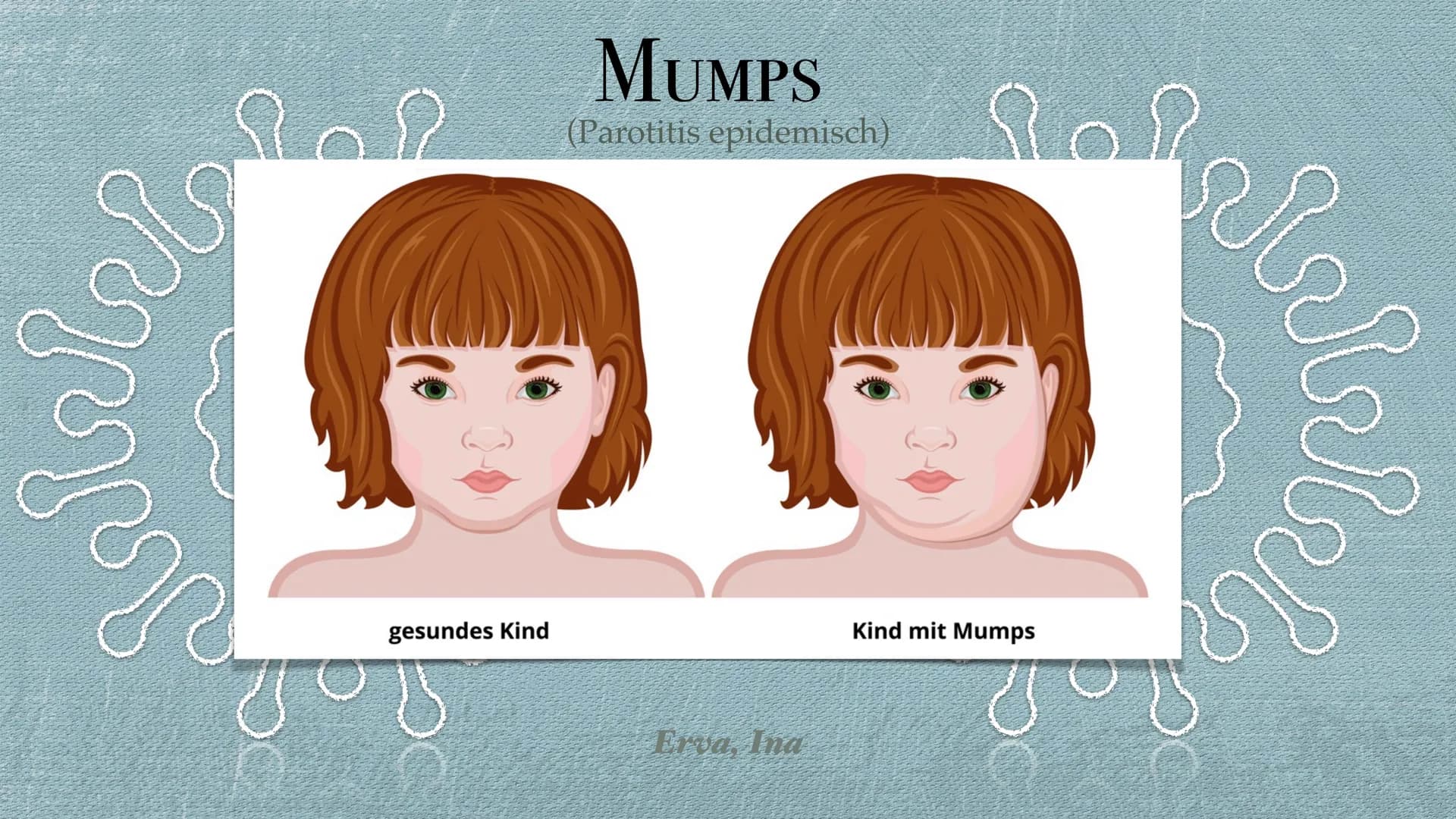 Pemas
gesundes Kind
MUMPS
(Parotitis epidemisch)
Erva, Ina
Kind mit Mumps Inhaltsverzeichnis
Symptomatik
Krankheitsverlauf
Erreger
Übertragu
