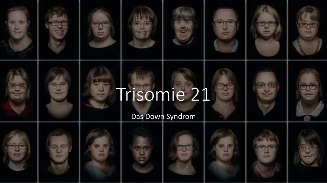 Trisomie 21 ( Das Down Syndrom ) 