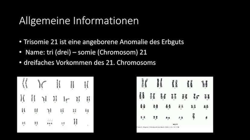 Trisomie 21
Das Down Syndrom Gliederung
●
●
●
●
Allgemeine Informationen
Krankheitsbild
Entdeckung - Geschichte
Entstehung - Ursachen - Risi