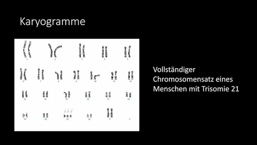 Trisomie 21
Das Down Syndrom Gliederung
●
●
●
●
Allgemeine Informationen
Krankheitsbild
Entdeckung - Geschichte
Entstehung - Ursachen - Risi