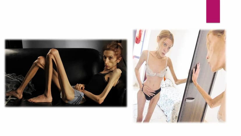 Magersucht
WARUM GERATEN SO VIELE MÄDCHEN IN DIESE LAGE? Gliederung
► Was ist Magersucht?
Allgemeines
Anzeichen
► Folgen
Behandlung
▸ Gründe