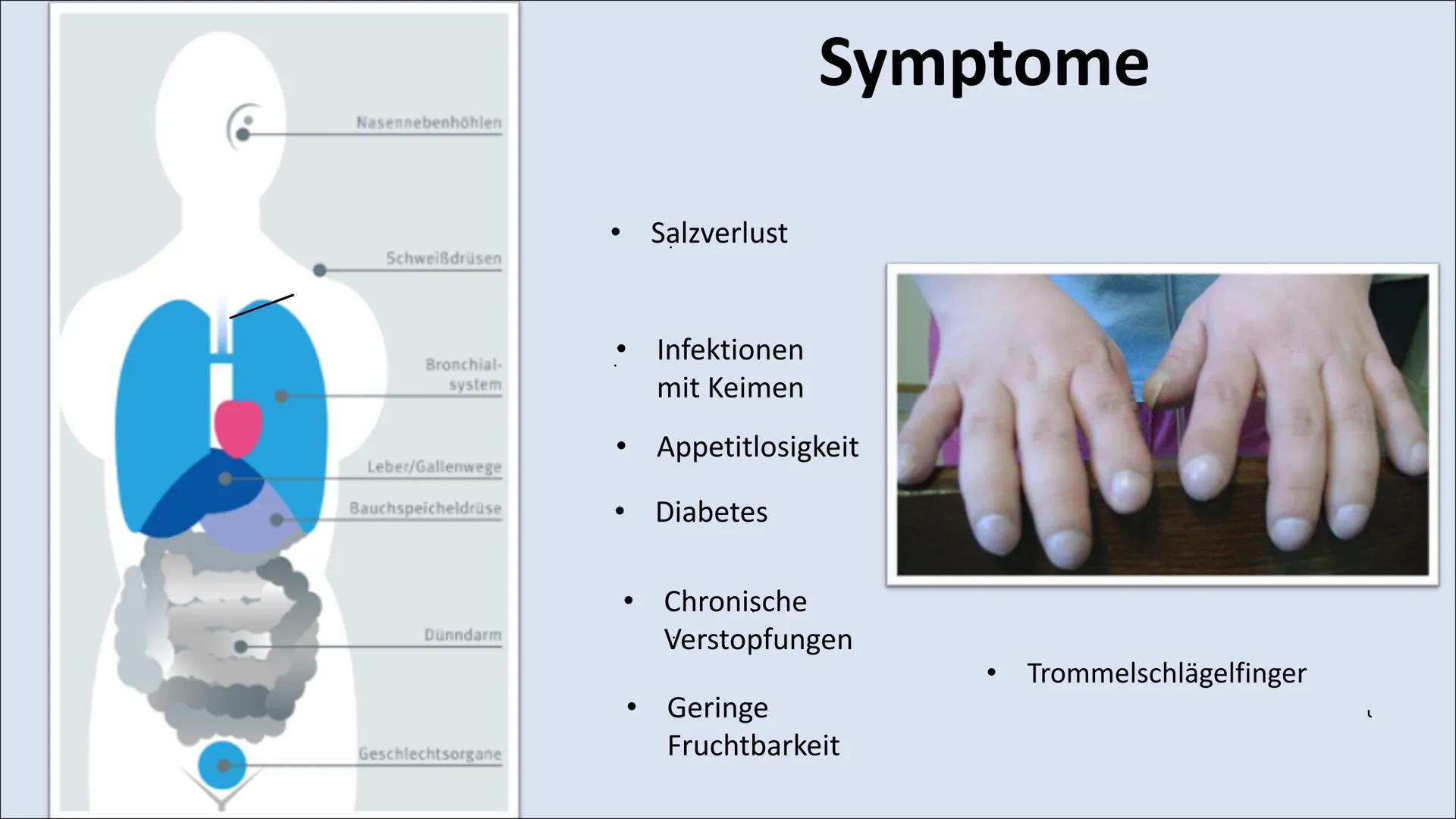 MUKOVISZIDOSE Gliederung

• Was ist Mukoviszidose ?
• Molekulargenetische
Ursachen
• Vererbung
• Häufigkeit/ Vorkommen
• Symptome
• Lebenser