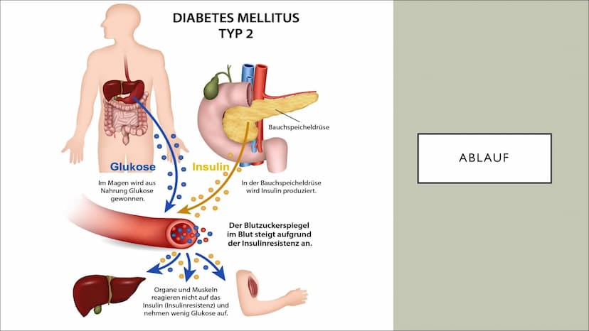 DIABETES MELLITUS
Von Fiona und Ceyda ●
Bedeutung und Geschichte
• Was ist Diabetes mellitus ?
Wie erkennt man, dass man Diabetes hat ?
Was 