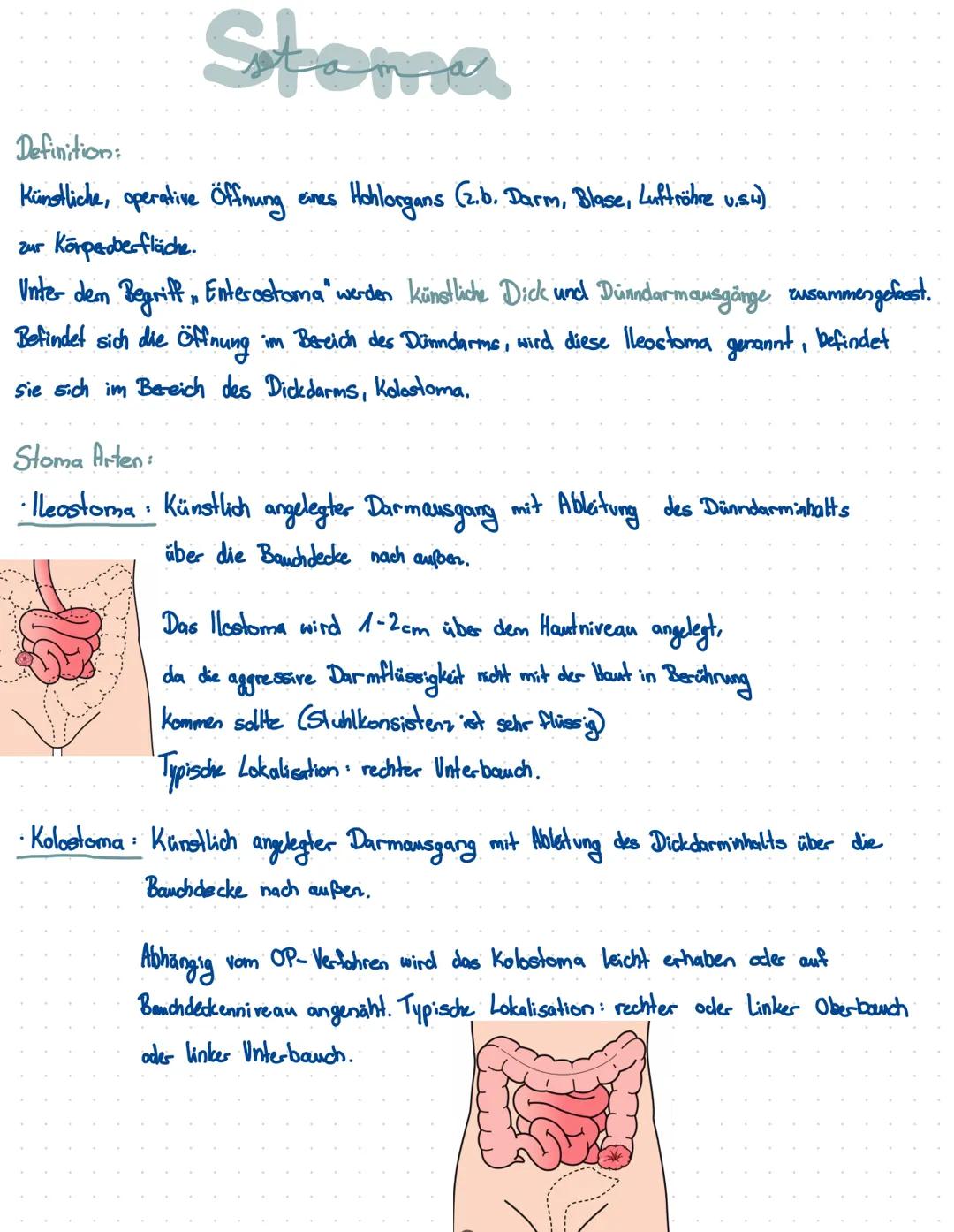 Stoma
Definition:
Künstliche, operative Öffnung
eines
Hohlorgans
(2.b. Darm, Blase, Luftröhre u.s.w)
zur Körperoberfläche.
Unter dem Begriff