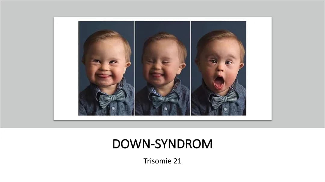 Down Syndrom Präsentation