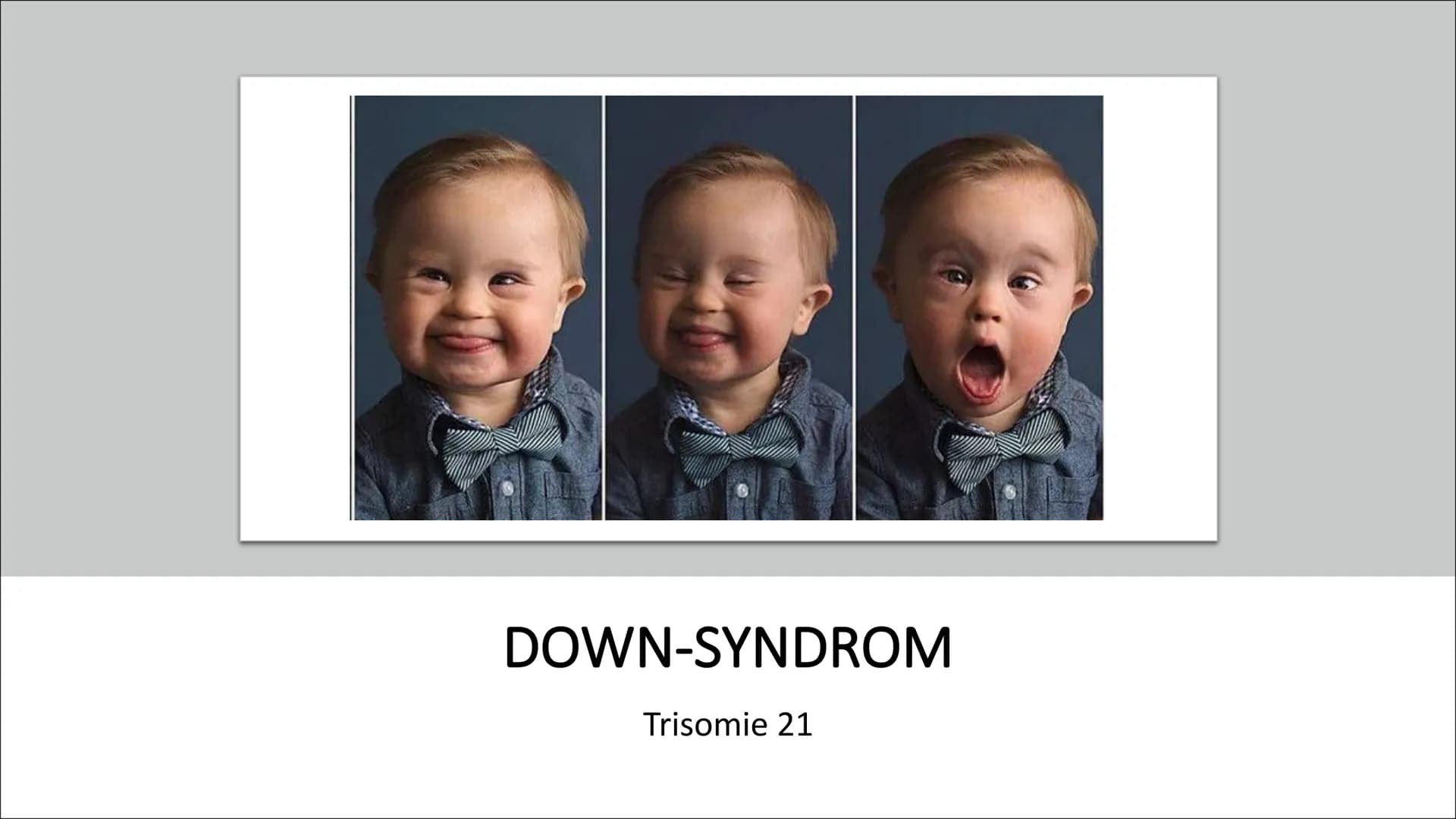 DOWN-SYNDROM
Trisomie 21 GLIEDERUNG
Was ist Trisomie 21?
Entdeckung
• Ursache und Risikofaktoren
Die drei unterschiedlichen Formen der Triso