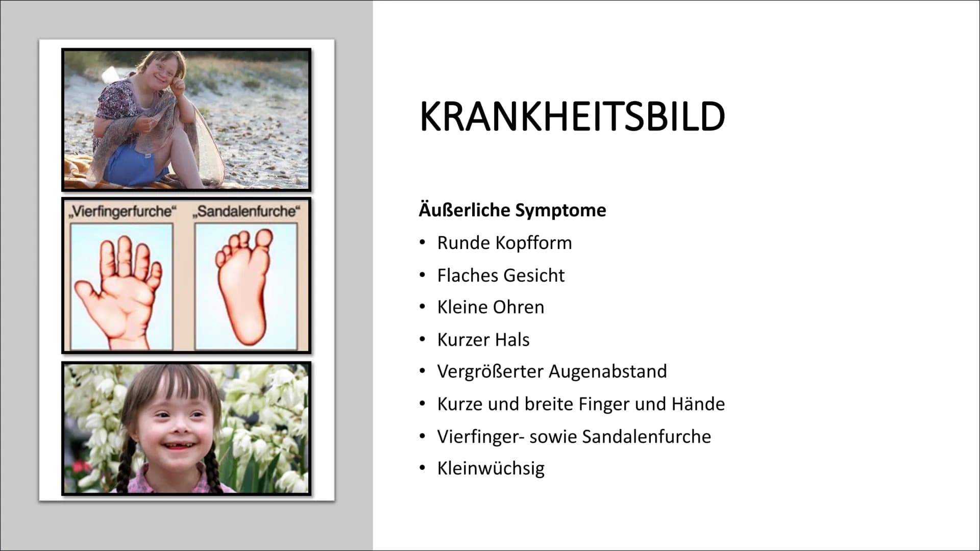 DOWN-SYNDROM
Trisomie 21 GLIEDERUNG
Was ist Trisomie 21?
Entdeckung
• Ursache und Risikofaktoren
Die drei unterschiedlichen Formen der Triso