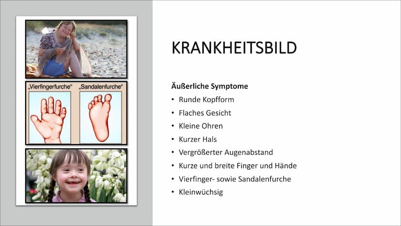 DOWN-SYNDROM
Trisomie 21 GLIEDERUNG
Was ist Trisomie 21?
Entdeckung
• Ursache und Risikofaktoren
Die drei unterschiedlichen Formen der Triso