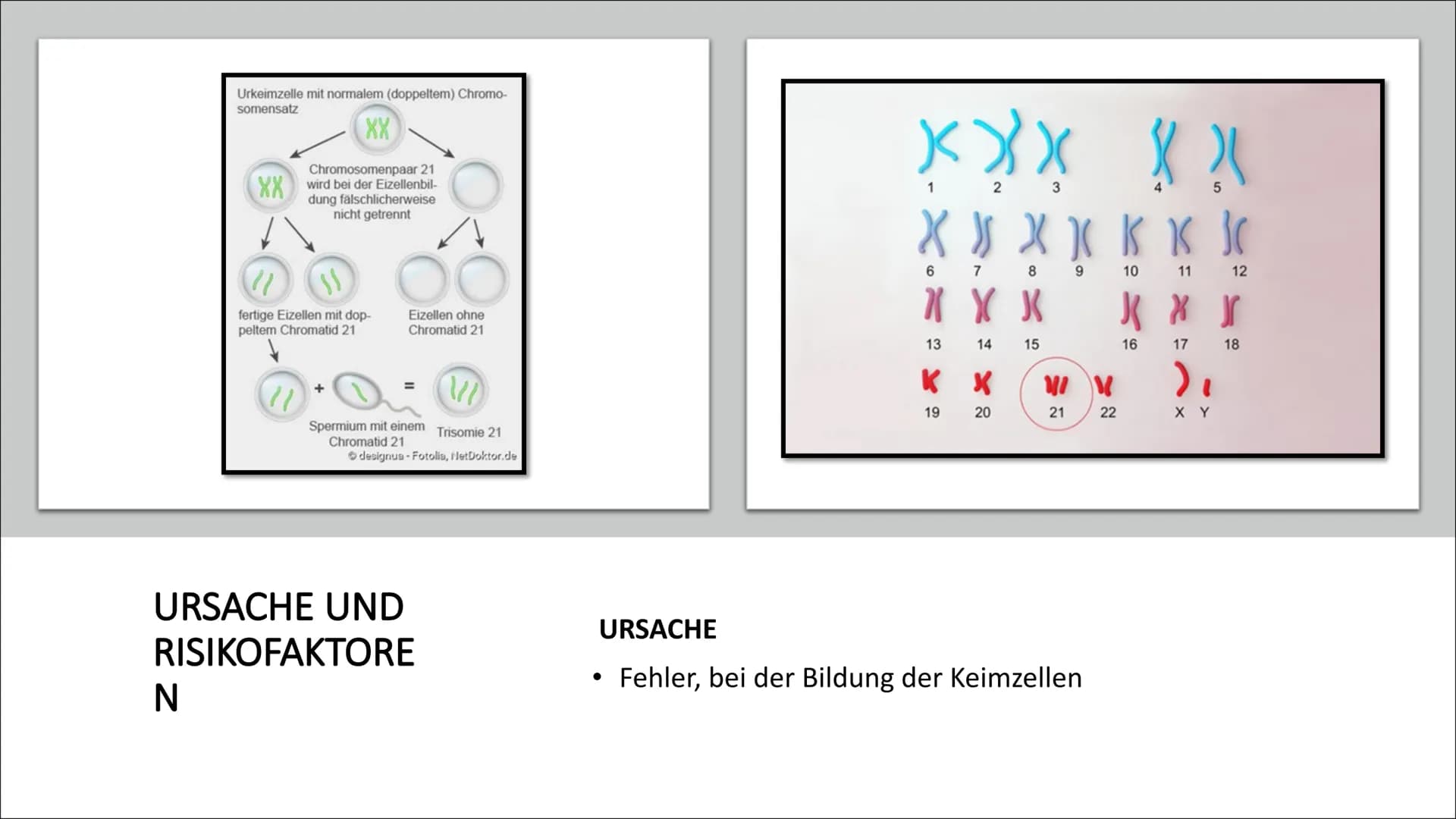 DOWN-SYNDROM
Trisomie 21 GLIEDERUNG
Was ist Trisomie 21?
Entdeckung
• Ursache und Risikofaktoren
Die drei unterschiedlichen Formen der Triso