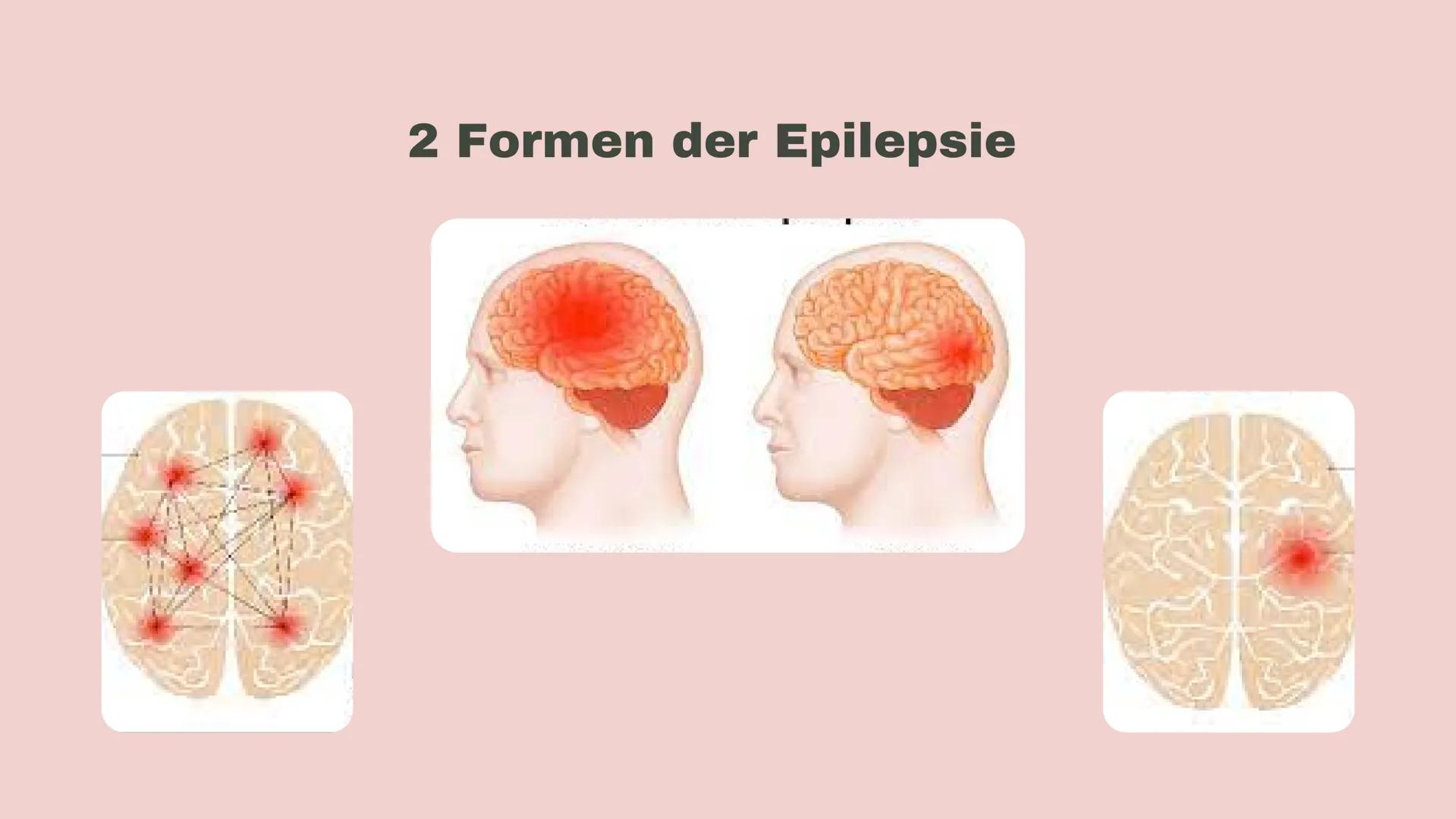 AMELIE MÖLLER
WENN DAS GEHIRN AUS
DEM TAKT GERÄT
Epilepsie GLIEDERUNG
01
02
03
04
Was ist Epilepsie?
Formen der Epilepsie
Ursachen
Diagnose 