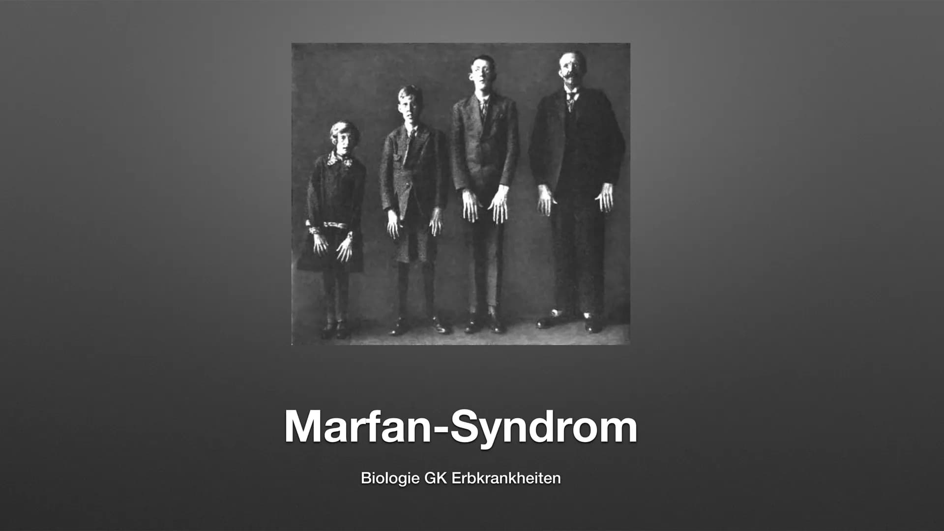 
<p>Das Marfan-Syndrom ist eine seltene genetische Erkrankung des Bindegewebes, die viele verschiedene Organe wie Knochen, Gelenke, Herz ode