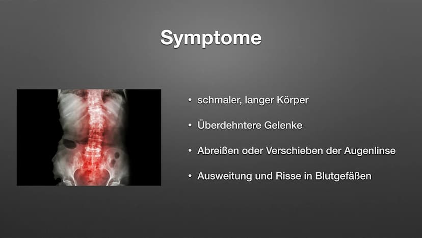 
<p>Das Marfan-Syndrom ist eine seltene genetische Erkrankung des Bindegewebes, die viele verschiedene Organe wie Knochen, Gelenke, Herz ode